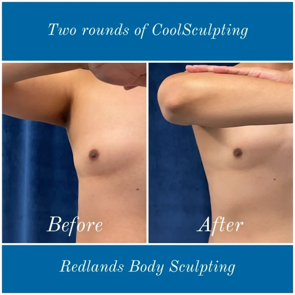 CoolSculpting Before and After photo by Redlands Body Sculpting in Redlands, CA