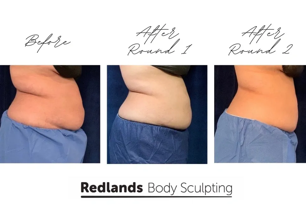 CoolSculpting Before and After photo by Redlands Body Sculpting in Redlands, CA