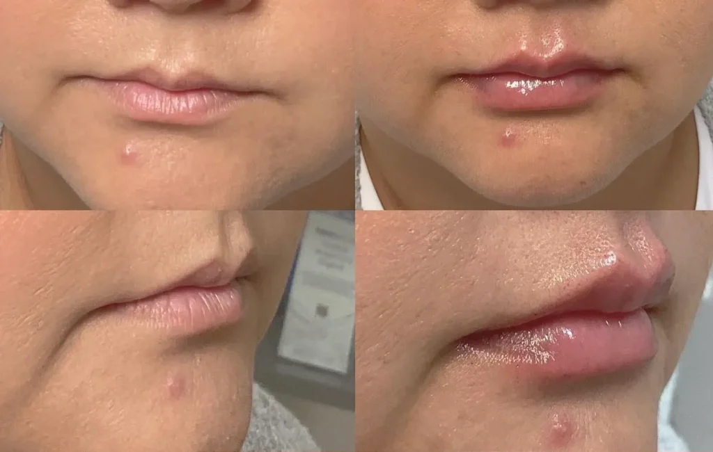 Injectables Before and After photo by Redlands Body Sculpting in Redlands, CA