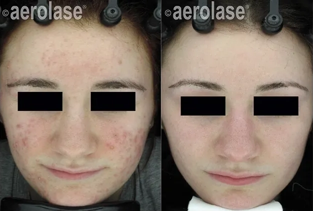 NeoClear® Laser Acne Treatment Before and After photo in Redlands, CA