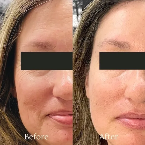 ToxBooster Before and After photo by Redlands Body Sculpting in Redlands, CA