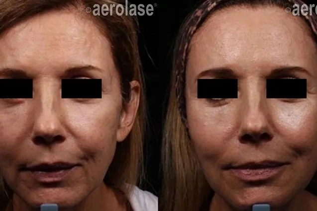 Aerolase NeoSkin Before and After photo in Redlands, CA