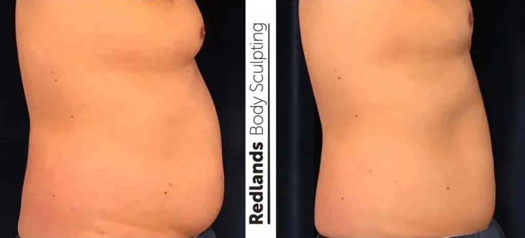 CoolSculpting Before and After photo by Redlands Body Sculpting in Redlands, CA