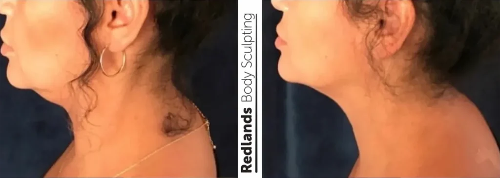 CoolSculpting Before and After photo by Redlands Body Sculpting in Redlands, CA