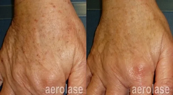 Aerolase NeoSkin Before and After photo in Redlands, CA