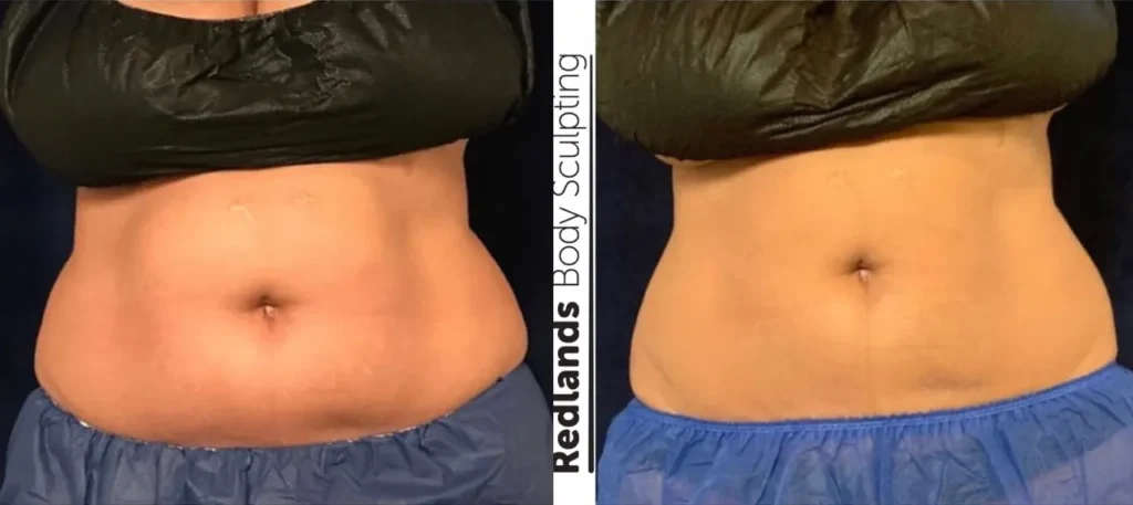 CoolSculpting Before and After photo by Redlands Body Sculpting in Redlands, CA