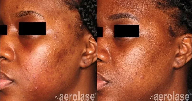 NeoClear® Laser Acne Treatment Before and After photo in Redlands, CA