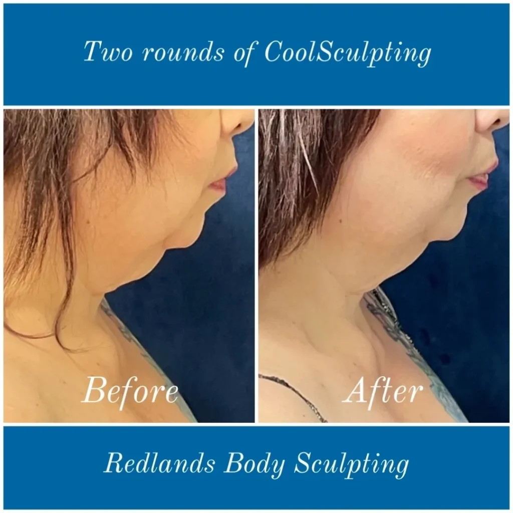 CoolSculpting Before and After photo by Redlands Body Sculpting in Redlands, CA