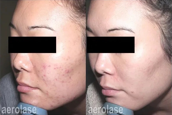 NeoClear® Laser Acne Treatment Before and After photo in Redlands, CA