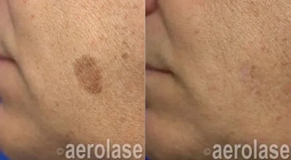 Aerolase NeoSkin Before and After photo in Redlands, CA