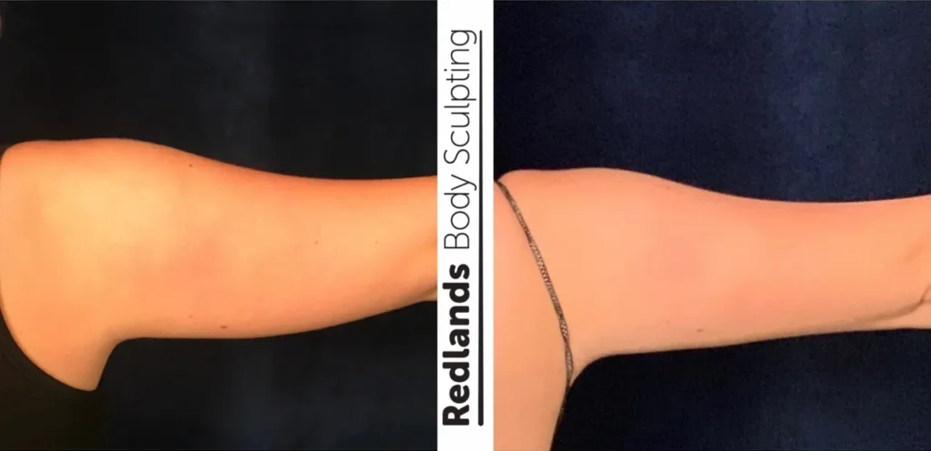 CoolSculpting Before and After photo by Redlands Body Sculpting in Redlands, CA