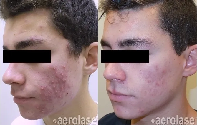 NeoClear® Laser Acne Treatment Before and After photo in Redlands, CA