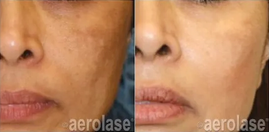 Aerolase NeoSkin Before and After photo in Redlands, CA