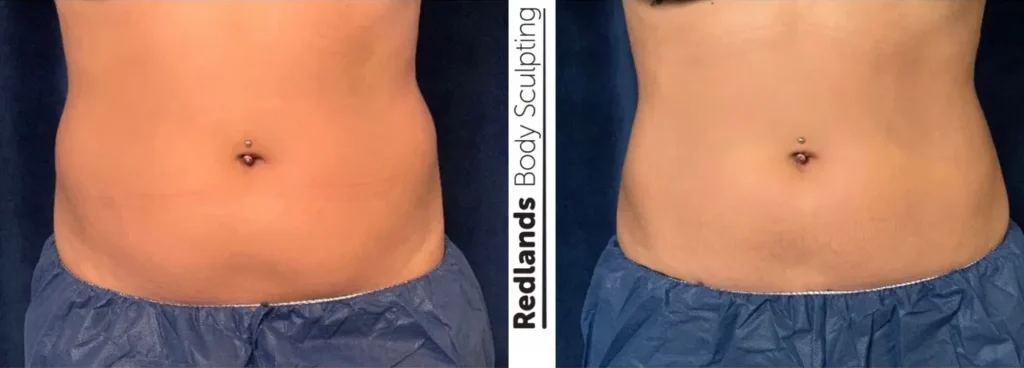 CoolSculpting Before and After photo by Redlands Body Sculpting in Redlands, CA