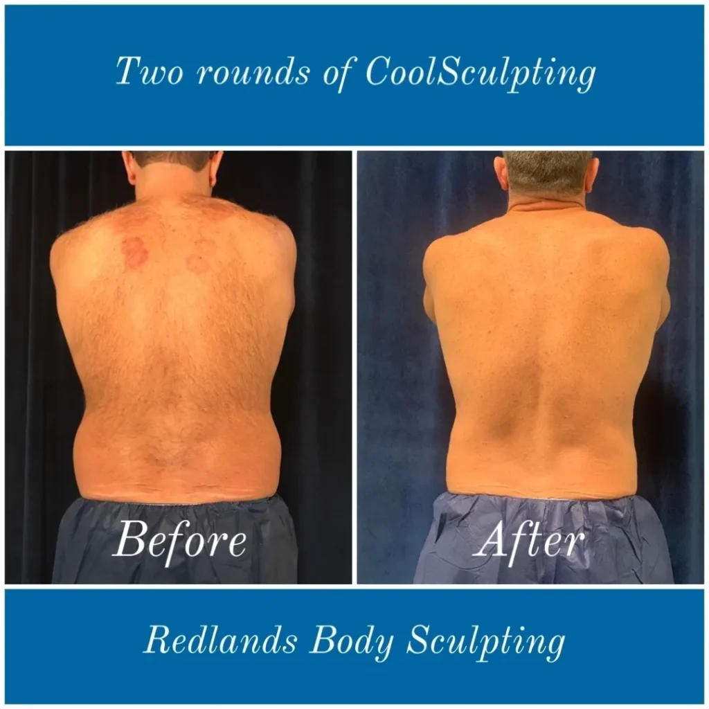 CoolSculpting Before and After photo by Redlands Body Sculpting in Redlands, CA