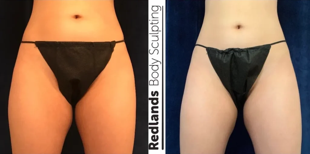 CoolSculpting Before and After photo by Redlands Body Sculpting in Redlands, CA