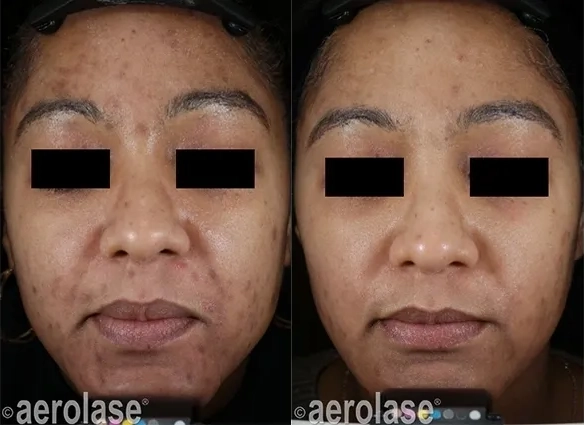 NeoClear® Laser Acne Treatment Before and After photo in Redlands, CA