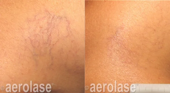 Aerolase Before and After photo by Redlands Body Sculpting in Redlands, CA