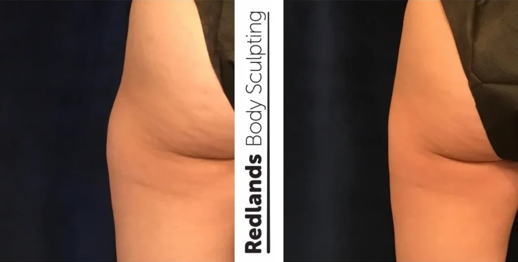 CoolSculpting Before and After photo by Redlands Body Sculpting in Redlands, CA