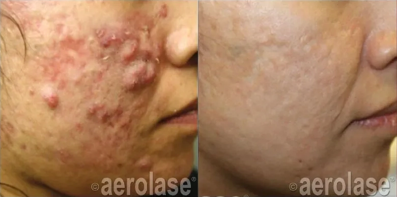 NeoClear® Laser Acne Treatment Before and After photo in Redlands, CA