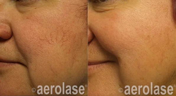 Aerolase Before and After photo by Redlands Body Sculpting in Redlands, CA