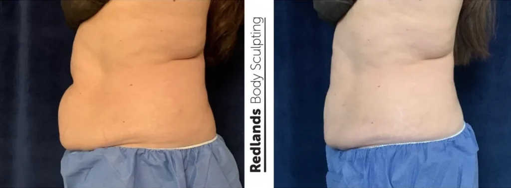 CoolSculpting Before and After photo by Redlands Body Sculpting in Redlands, CA