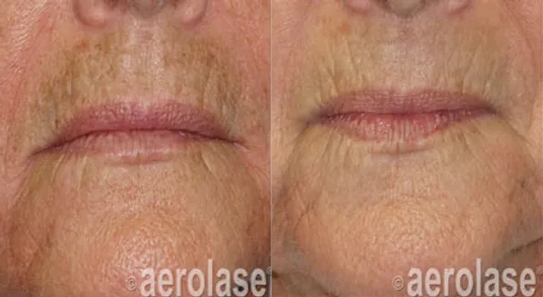 Aerolase Before and After photo by Redlands Body Sculpting in Redlands, CA