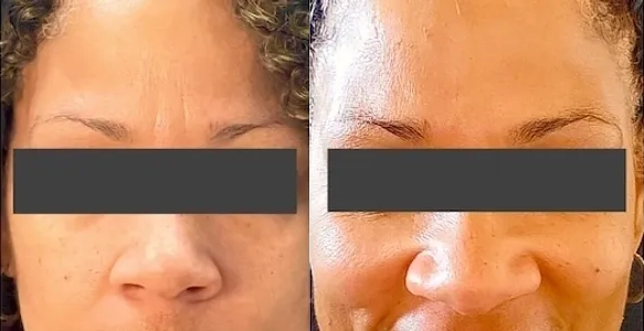 Botox/Dysport Before and After photo by Redlands Body Sculpting in Redlands, CA