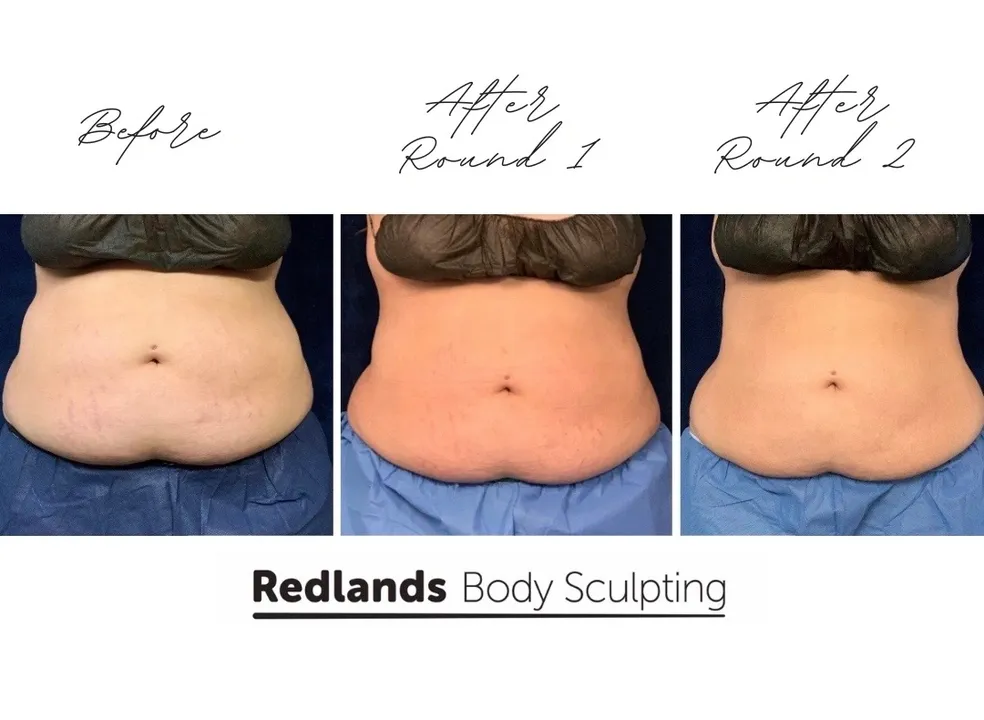 CoolSculpting Before and After photo by Redlands Body Sculpting in Redlands, CA