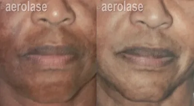 Aerolase Before and After photo by Redlands Body Sculpting in Redlands, CA