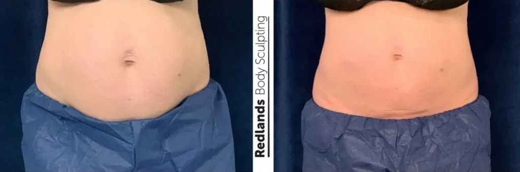 CoolSculpting Before and After photo by Redlands Body Sculpting in Redlands, CA