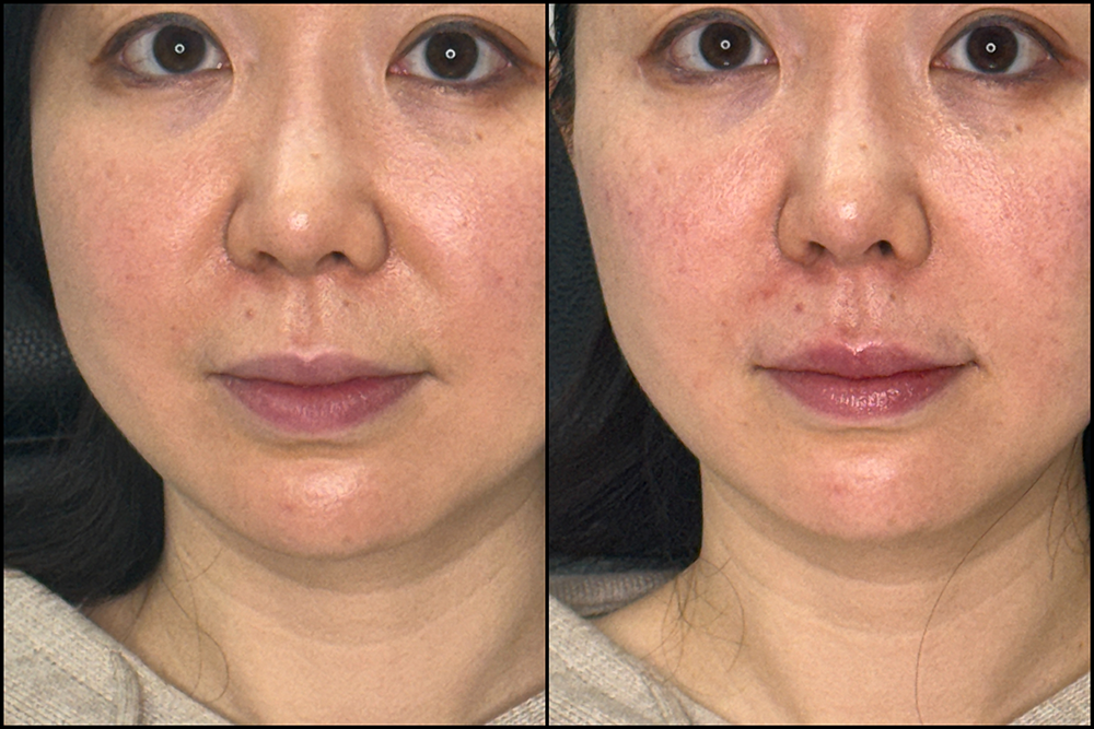 before and after cheek and chin filler at RedLands Body Sculpting with Dr. Aya in California